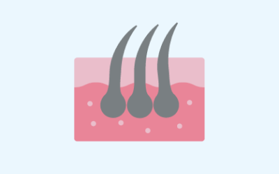 Simple cross-section diagram of the skin with 3 hair follicles and inflamed skin tissue.