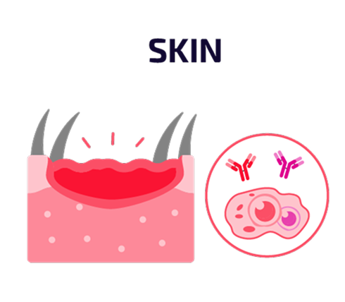 Graphic labeled “Skin” showing an inflamed skin cross-section diagram beside icons of autoantibodies interacting with skin cells.